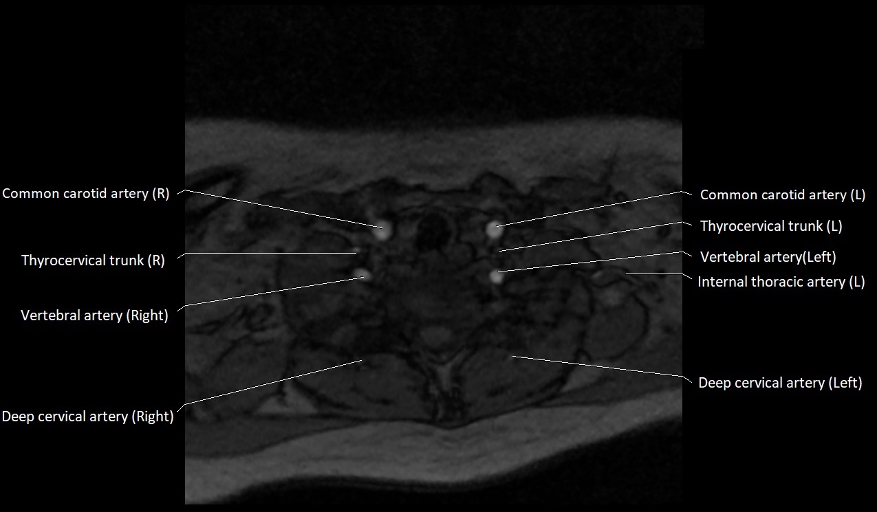 Carotid artery anatomy axial 3T image 62.jpg